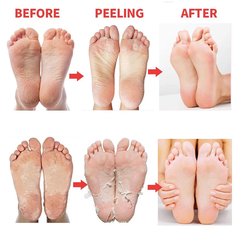 LANBENA VIT.C FOOT PEEL MASK REMOVE CALLUSE 1PAIR - Image 2